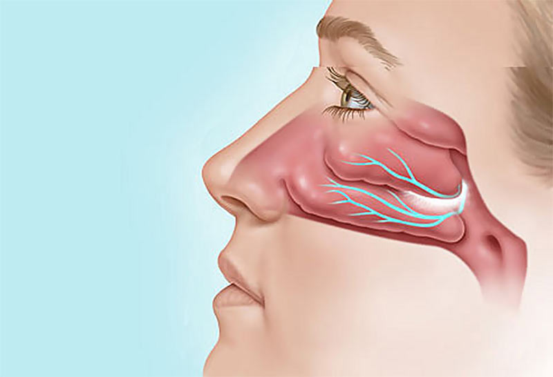 chronic Rhinitis
